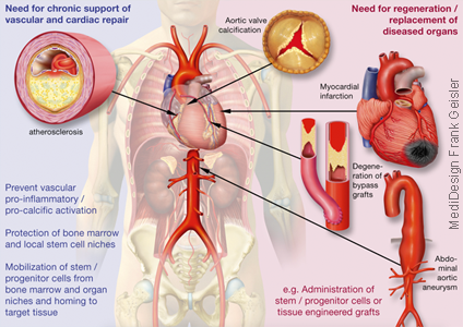 Grafikdesign Poster Kardiologie Herzerkrankung Arteriosklerose Herzinfarkt des Menschen